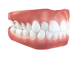 CROSS BITE
